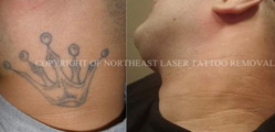 laser-tattoo-removal